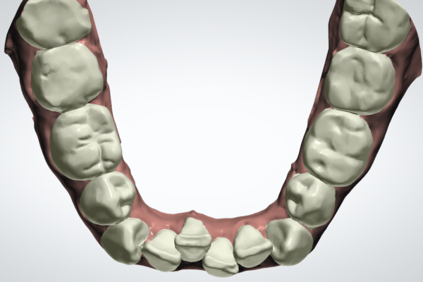 Czy za pomocą szyn CA (Clear Aligner) można wyprostować zęby które są „ściśnięte”?